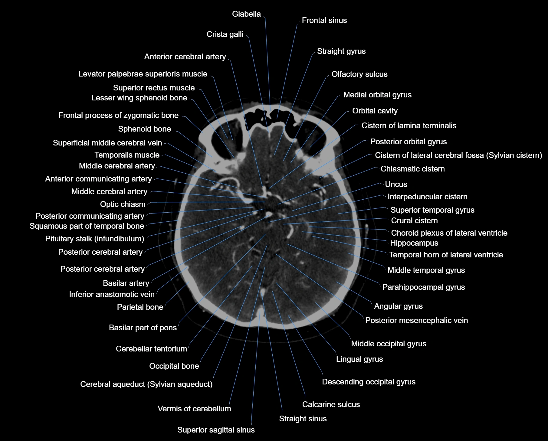 CT scan brain axial labelled cross sectional anatomy image-img-000028.webp